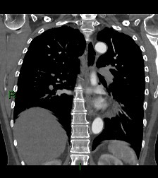 File:Aortic valve endocarditis (Radiopaedia 87209-103485 D 26).jpg
