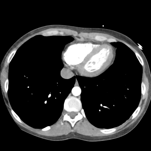 File:Aortic valve non-coronary cusp thrombus (Radiopaedia 55661-62189 B 38).png