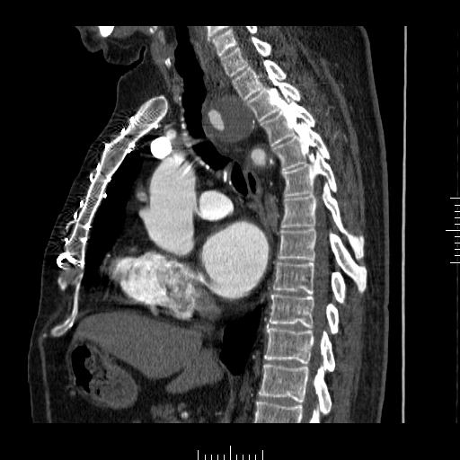 File:Aorto-coronary bypass graft aneurysms (Radiopaedia 40562-43157 C 17).png