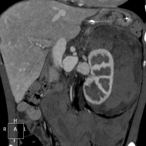 Aorto-left renal vein fistula (Radiopaedia 45534-49628 B 26).jpg