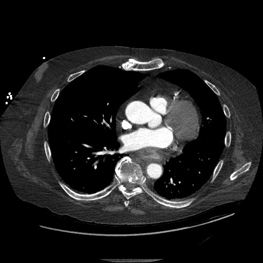 Aortoesophageal fistula with endovascular repair (Radiopaedia 73781-84592 Axial C+ CTPA 92).jpg