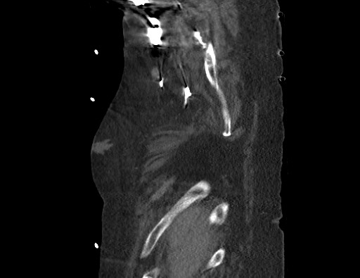 Aortoesophageal fistula with endovascular repair (Radiopaedia 73781-84592 Sagittal C+ CTPA 2).jpg
