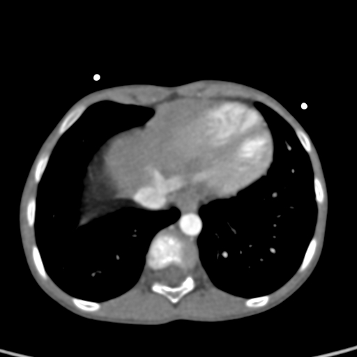 File:Aortopulmonary window, interrupted aortic arch and large PDA giving the descending aorta (Radiopaedia 35573-37074 B 75).jpg