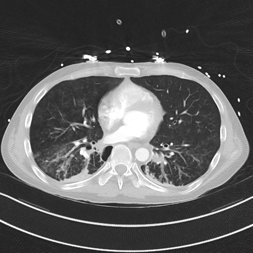 Apical bullous disease in a heavy smoker (Radiopaedia 33067-34092 Axial lung window 39).png