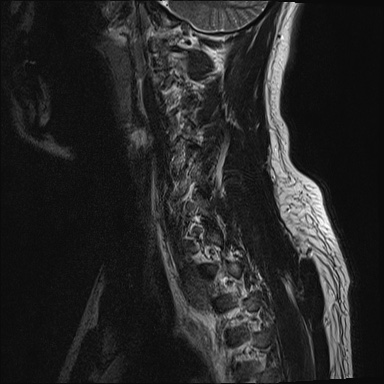 File:Apical lung mass mimic - neurogenic tumor (Radiopaedia 59918-67394 Sagittal T2 15).jpg