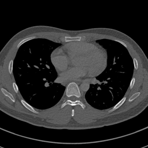 File:Apical lung mass mimic - neurogenic tumor (Radiopaedia 59918-67521 Axial bone window 47).jpg