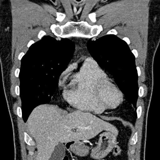 Apical lung mass mimic - neurogenic tumor (Radiopaedia 59918-67521 B 44).jpg