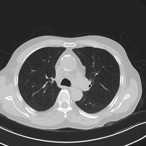 Apical pulmonary metastasis (Radiopaedia 46338-50754 Axial non-contrast 26).png