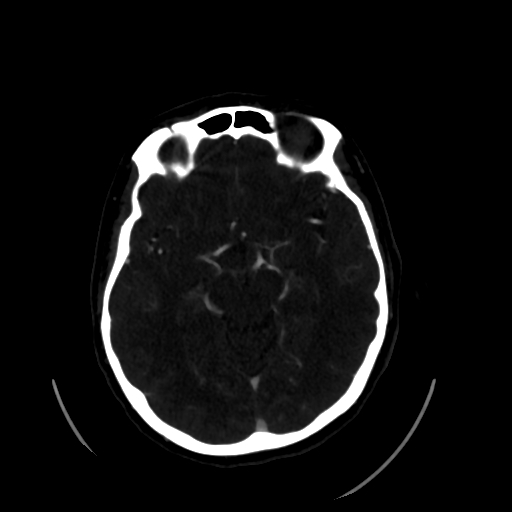 File:Aplasia of the internal carotid artery (Radiopaedia 61082-68960 A 30).jpg
