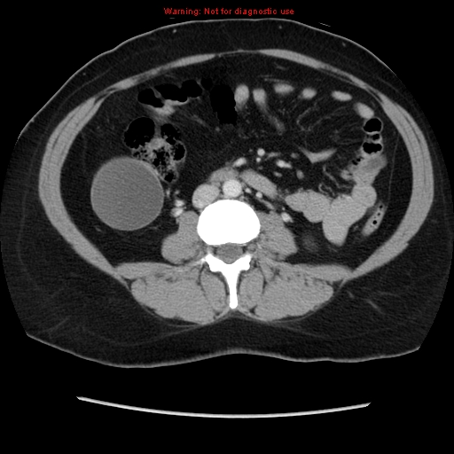 Appendiceal mucinous cystadenoma (Radiopaedia 8263-9111 Axial liver window 44).jpg