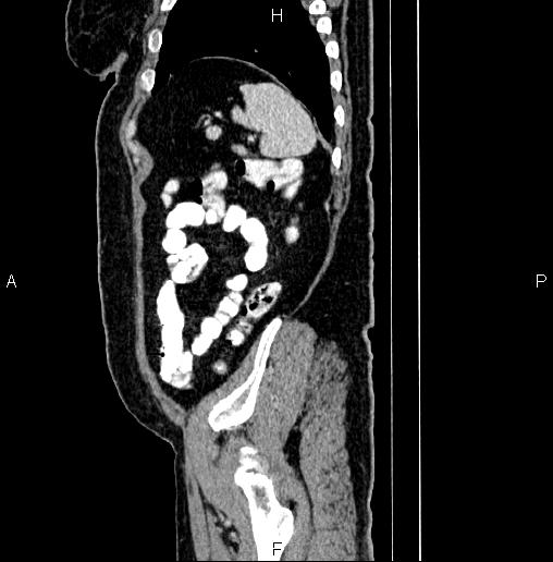 Appendiceal mucocele (Radiopaedia 82952-97298 D 95).jpg