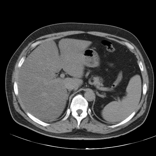 File:Appendicitis and giant appendicolith (Radiopaedia 80251-93588 Axial non-contrast 8).jpg