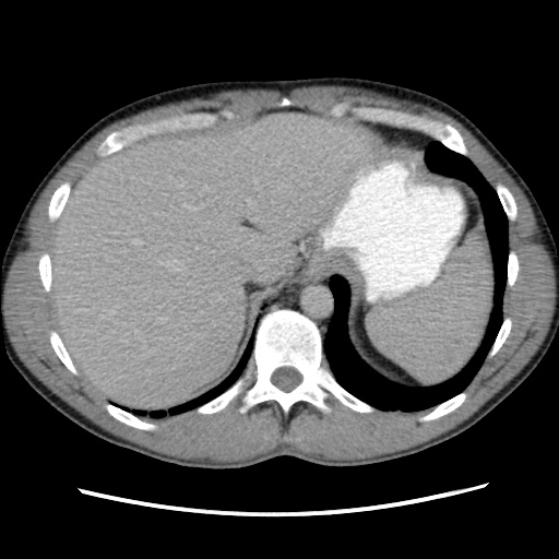 File:Appendicitis complicated by post-operative collection (Radiopaedia 35595-37114 A 17).jpg