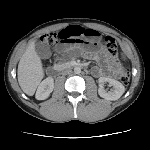Appendicitis complicated by post-operative collection (Radiopaedia 35595-37114 A 37).jpg