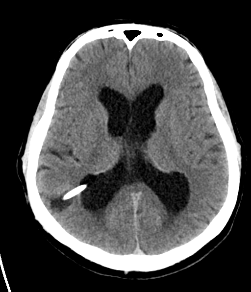 File:Aqueduct stenosis with corpus callosum hypoattenuation post shunting (Radiopaedia 37212-38973 Axial non-contrast 17).png