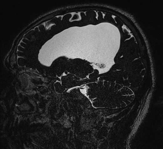 File:Aqueduct stenosis with spontaneous 3rd ventriculostomy (Radiopaedia 74381-85267 A 67).jpg