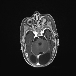 Aqueductal stenosis (Radiopaedia 73974-84802 Axial T1 C+ 58).jpg