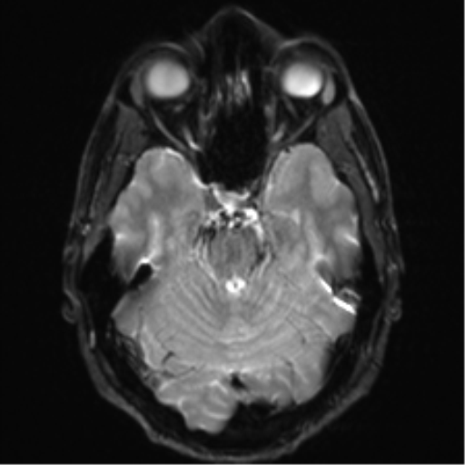 Arachnoid cyst - cerebellopontine angle (Radiopaedia 59689-67083 Axial DWI 12).png