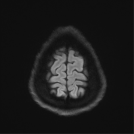 Arachnoid cyst - cerebellopontine angle (Radiopaedia 59689-67083 Axial DWI 69).png