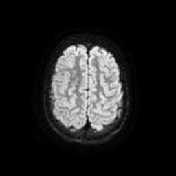 Arachnoid cyst - middle cranial fossa (Radiopaedia 67671-77088 Axial DWI 23).jpg