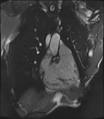 File:Arrhythmogenic right ventricular cardiomyopathy (Radiopaedia 57972-64966 CINE R2 SSFP 82).jpg