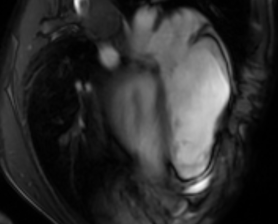 File:Arrhythmogenic right ventricular cardiomyopathy (Radiopaedia 69564-79464 4ch cine 101).jpg
