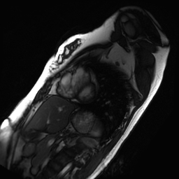 Arrhythmogenic right ventricular cardiomyopathy (Radiopaedia 87505-103850 short axis Cine SSFP 90).jpg
