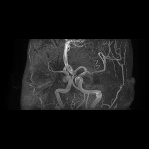 Arteriovenous malformation (Radiopaedia 71628-81999 Axial MRA 9).jpg