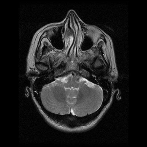 File:Arteriovenous malformation (cerebral) (Radiopaedia 40070-42580 Axial T2 6).png
