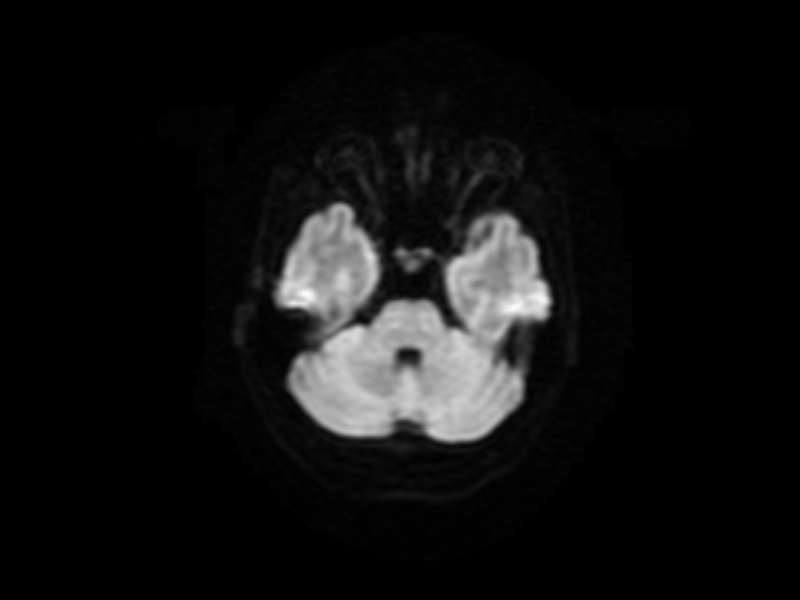 File:Artery of Percheron infarct (Radiopaedia 36897-38526 Axial DWI 5).jpg