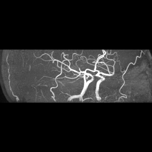 Artery of Percheron infarction (Radiopaedia 27975-28230 3D TOF 16).jpg