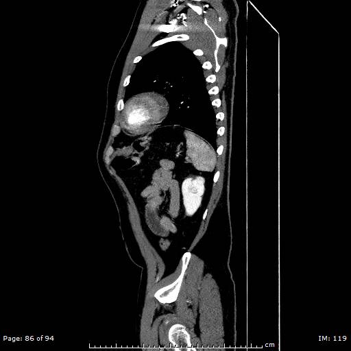 Ascending aortic aneurysm (Radiopaedia 50086-55404 C 61).jpg
