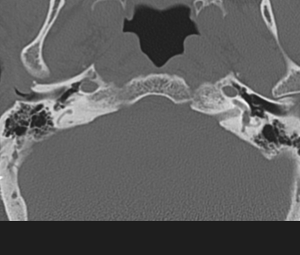 Atlanto-axial subluxation (Radiopaedia 36610-38176 Axial bone window 4).png