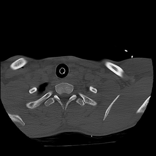 Atlanto-occipital dissociation (Traynelis type 1), C2 teardrop fracture, C6-7 facet joint dislocation (Radiopaedia 87655-104061 Axial bone window 89).jpg