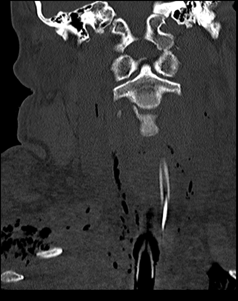 Atlanto-occipital dissociation - Traynelis type 1 (Radiopaedia 87570-103948 Coronal bone window 26).jpg