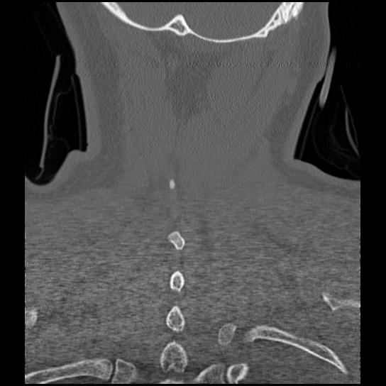 Atlanto-occipital dissociation injury (Radiopaedia 29274-29698 Coronal bone window 3).png