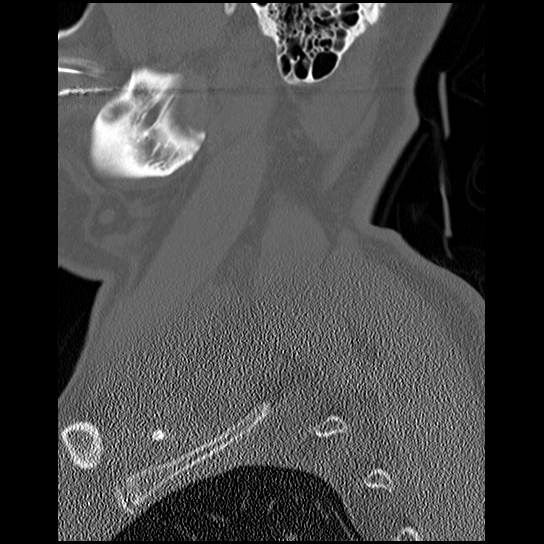 File:Atlanto-occipital dissociation injury (Radiopaedia 29274-29698 Sagittal bone window 4).png
