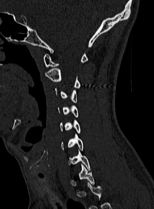 Atlantoaxial subluxation (Radiopaedia 44681-48450 Sagittal bone window 35).jpg