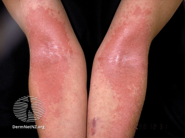 File:Atopic dermatitis (DermNet NZ eczema-elbows-001).jpg