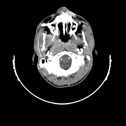 File:Atypical 2nd branchial cleft cyst (type IV) - infected (Radiopaedia 20986-20924 A 2).jpg