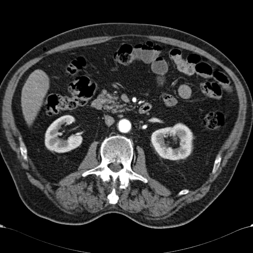 Atypical hepatocellular carcinoma (Radiopaedia 41744-44698 A 48).jpg