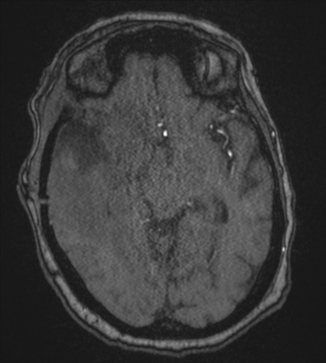 Atypical meningioma (WHO Grade II) (Radiopaedia 54742-60981 Axial MRA 43).png