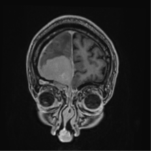 Atypical meningioma (WHO grade II) with brain invasion (Radiopaedia 57767-64729 Coronal T1 C+ 9).png