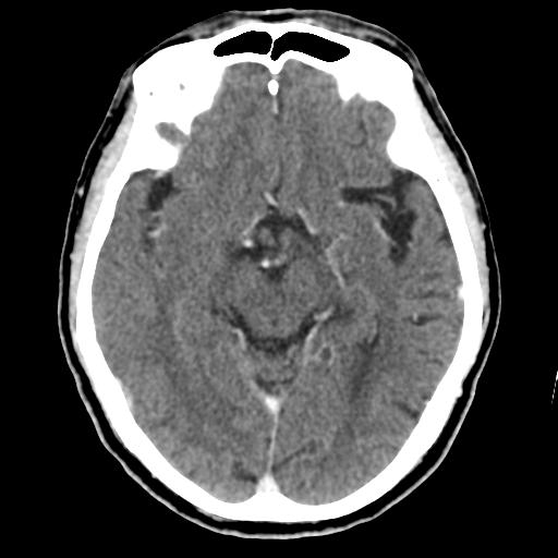 File:Atypical meningioma (WHO grade II) with osseous invasion (Radiopaedia 53654-59715 Axial C+ delayed 24).png