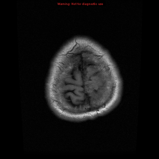 File:Atypical meningioma - grade II (Radiopaedia 13303-13305 Axial T1 21).jpg