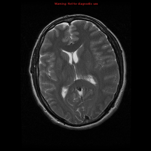 File:Atypical meningioma - grade II (Radiopaedia 13303-13305 Axial T2 12).jpg