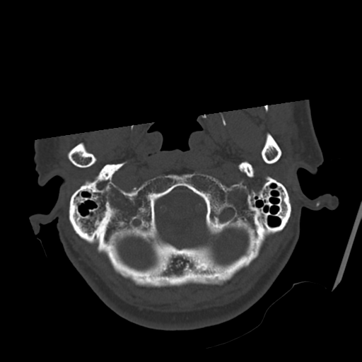 Atypical meningioma with skull invasion (Radiopaedia 34357-35649 Axial bone window 11).png