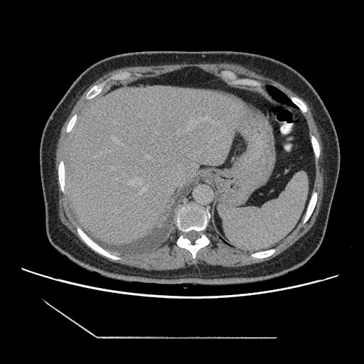 File:Atypical retroperitoneal lymphocoeles with large leiomyoma of uterus (Radiopaedia 32084-33024 A 11).jpg