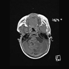 Atypical teratoid rhabdoid tumor (prenatal US and neonatal MRI) (Radiopaedia 59091-66388 Axial T1 13).jpg