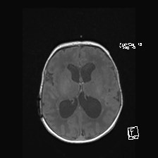 Atypical teratoid rhabdoid tumor (prenatal US and neonatal MRI) (Radiopaedia 59091-66388 Axial T1 34).jpg